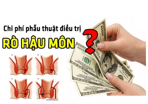 Chi phí điều trị rò hậu môn hết bao tiền?