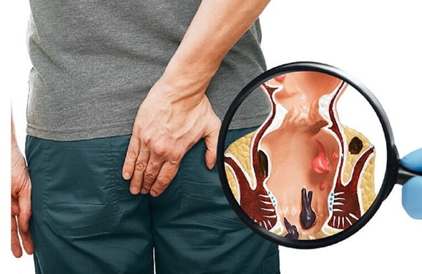 Vì sao cần chữa áp xe hậu môn ?