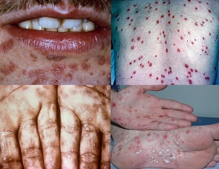 Những nguy hiểm của giang mai khi chữa muộn