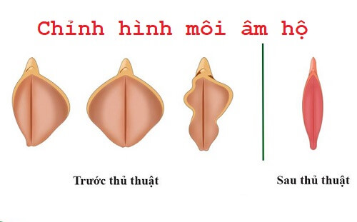 Chỉnh hình môi âm hộ