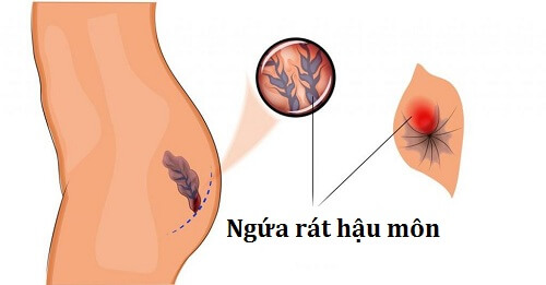 Ngứa rát hậu môn