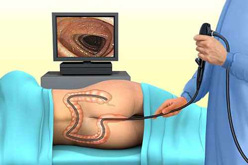 Chữa bệnh trĩ bằng phương pháp phẫu thuật