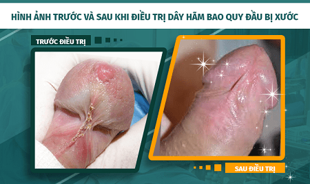 Chữa đứt dây hãm bao quy đầu ở đâu - Vì sao cần chữa đứt dây hãm bao quy đầu?