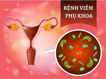 Viêm phụ khoa là gì ?