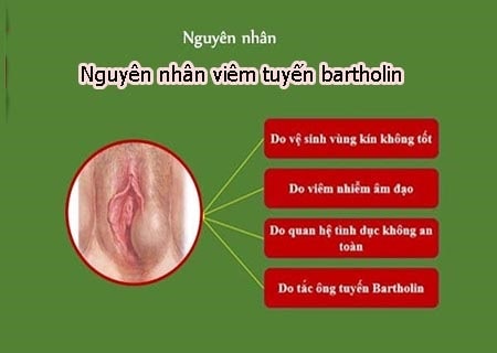 Nguyên nhân nào gây ra tình trạng viêm tuyến bartholin mãn tính?