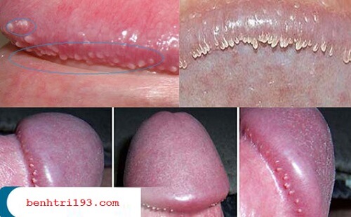 Chuỗi hạt ngọc bao quy đầu