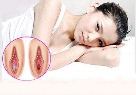 Biến chứng khi vá trinh tại địa chỉ kém chất lượng