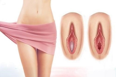 Tổng hợp nguyên nhân khiến màng trinh bị rách