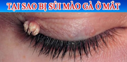Con đường lây truyền sùi mào gà ở khóe mắt