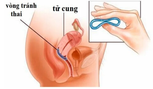 Đặt vòng tránh thai có đau không?