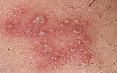  Mụn rộp sinh dục