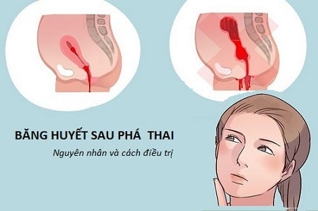 Dấu hiệu băng huyết sau phá thai là như thế nào?