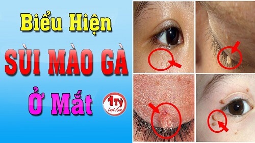 Dấu hiệu bệnh sùi mào gà ở mắt