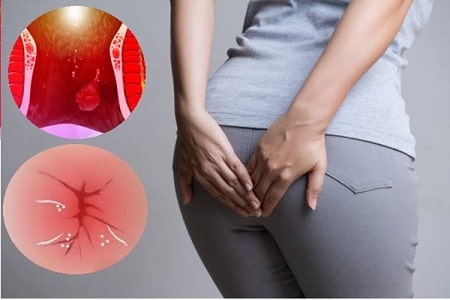 Nữ giới mắc bệnh trĩ có thể tự chữa trị ở nhà không?