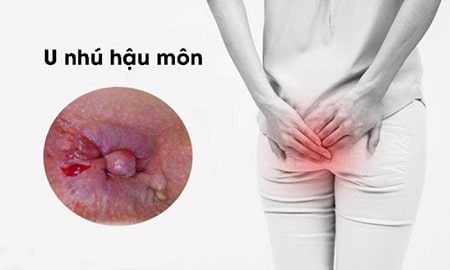 Đâu là những dấu hiệu bệnh trĩ tái phát cần lưu ý ?