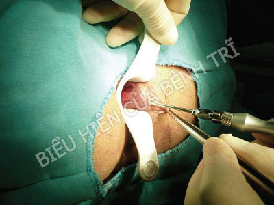 Dấu hiệu nhận biết của bệnh trĩ nội