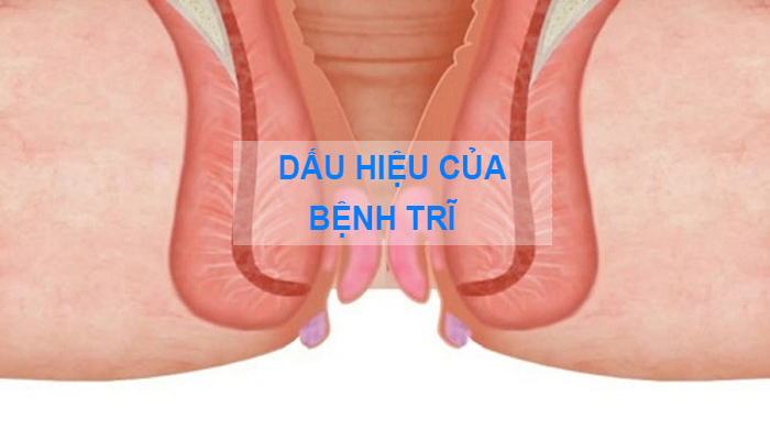 Tìm hiểu dấu hiệu của bệnh trĩ