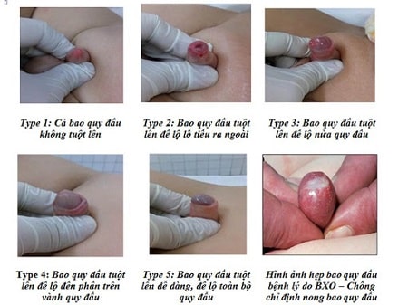 Nguyên nhân dẫn đến dấu hiệu hẹp bao quy đầu ở trẻ