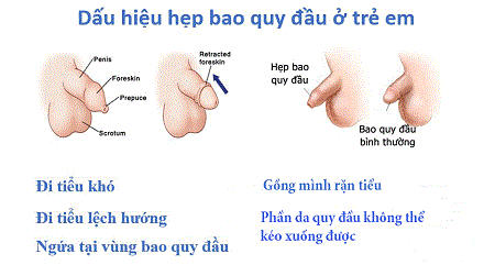 Dấu hiệu hẹp bao quy đầu ở trẻ là gì?