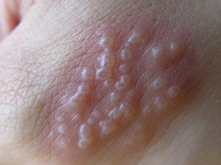 Nguyên nhân bị mụn rộp sinh dục do đâu ? 