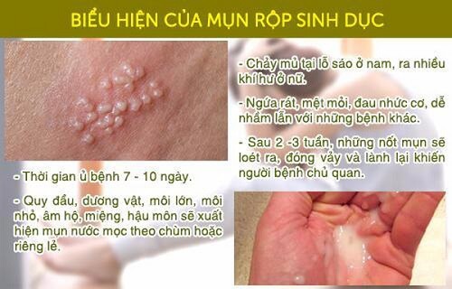 Mụn rộp sinh dục biểu hiện dễ nhận biết