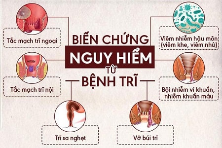 Mắc bệnh trĩ ngoại tuyệt tối không nên coi thường