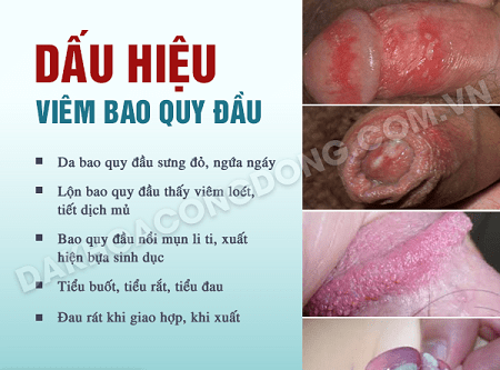 Dấu hiệu viêm bao quy đầu là gì ?
