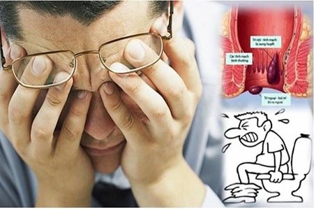 Tuyệt đối đừng trì hoãn việc đi khám nếu mắc trĩ ngoại