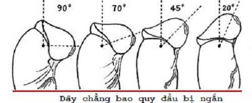 Dây chằng bao quy đầu bị ngắn