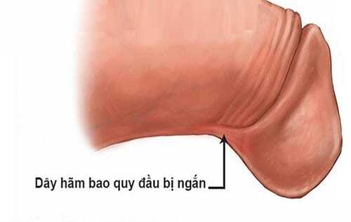 Dây hãm bao quy đầu bị ngắn