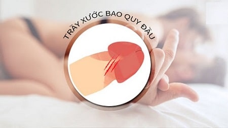 Những nguyên nhân dây hãm bao quy đầu bị xước do đâu?