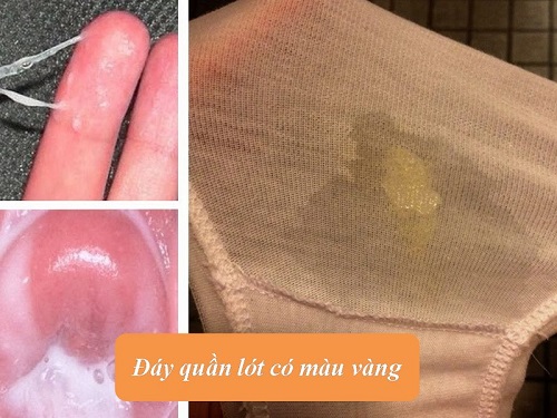 Đáy quần lót có màu vàng 