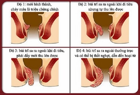 Bệnh trĩ là gì? Nên cắt trĩ không?