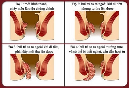 Bệnh trĩ là gì? Nên cắt trĩ không?