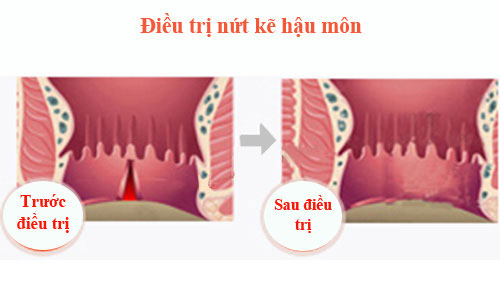 điều trị nứt kẽ hậu môn dứt điểm