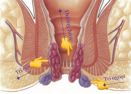 Trĩ ngoại là gì ?