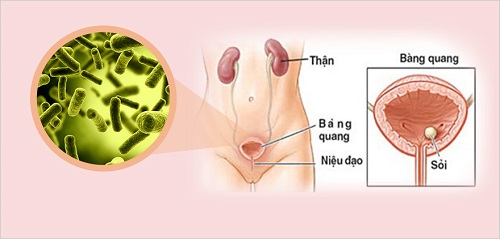 Dương vật mọc mụn trắng do bệnh viêm đường tiết niệu