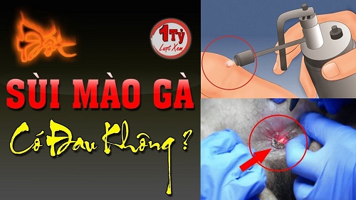 Đốt sùi mào gà ở miệng