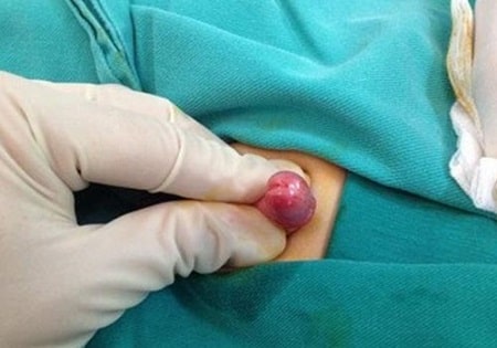 Làm sao để khắc phục được tình trạng dương vật bé ?