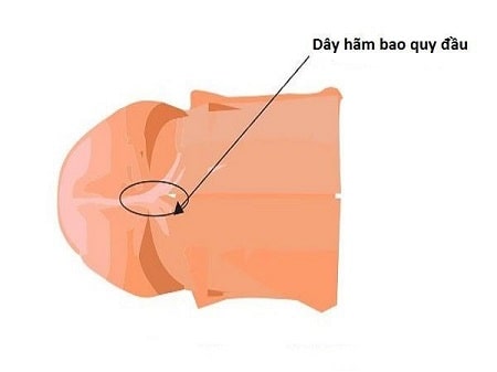 Đứt dây hãm bao quy đầu là gì ?
