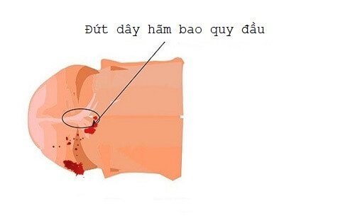 Đứt dây hãm bao quy đầu gây chảy máu, đau đớn 