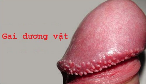 Bị mụn ở bao quy đầu- Biểu hiện bệnh gai dương vật