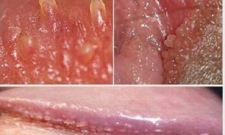 Gai sinh dục có nguy hiểm không?