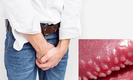 Gai bộ phận sinh dục thường mọc ở đâu?