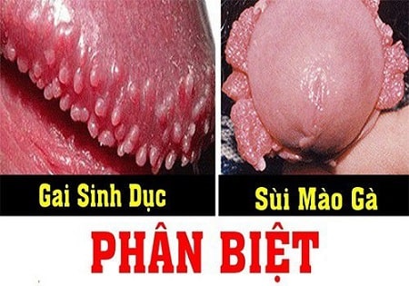 Phân biệt mụn gai sinh dục nam với sùi mào gà, mụn rộp sinh dục