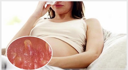 Gai sinh dục ở phụ nữ mang thai là gì ?