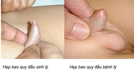 Cha mẹ cần lưu ý những gì khi trẻ bị hẹp bao quy đầu?