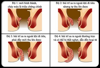 Hiện tượng sa búi trĩ của trĩ hỗn hợp