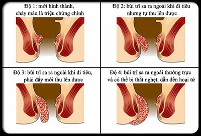 Hiện tượng sa búi trĩ