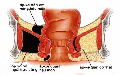 hình ảnh áp xe hậu môn